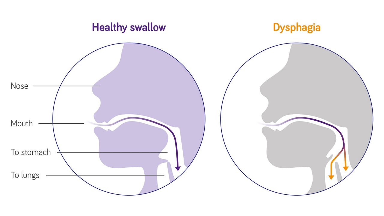 dysphagia after stroke icd 10